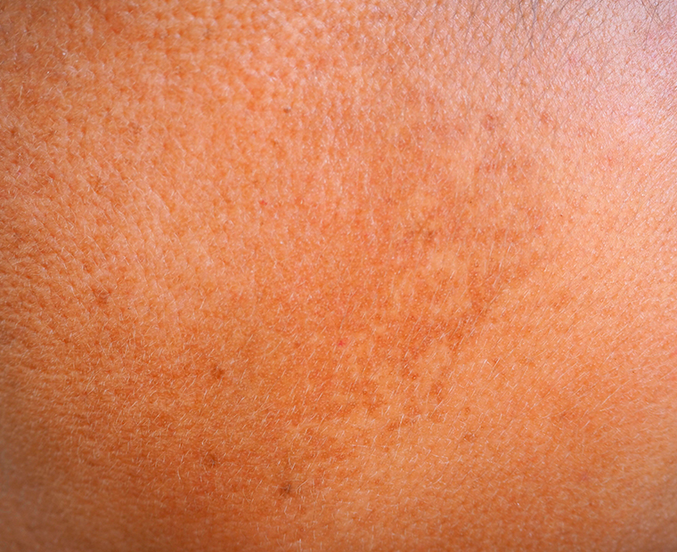 Brown Spots Removal is Easy and Safe