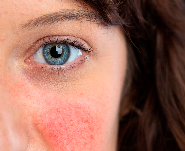 Rosacea Removal is Easy and Safe